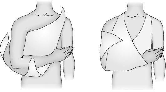 Косынка при переломе ключицы. Вывих плеча Косыночная повязка. Косыночная при переломе ключицы. Косыночная повязка для иммобилизации верхней конечности. Косыночная повязка на плечо наложение.